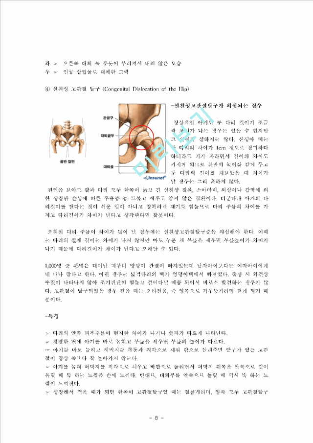 [의학,약학][의학] 고관절 전치술, 슬관절 전치술 -THR [Total Hip Replacement], TKR[Total Knee Replacement]   (8 )